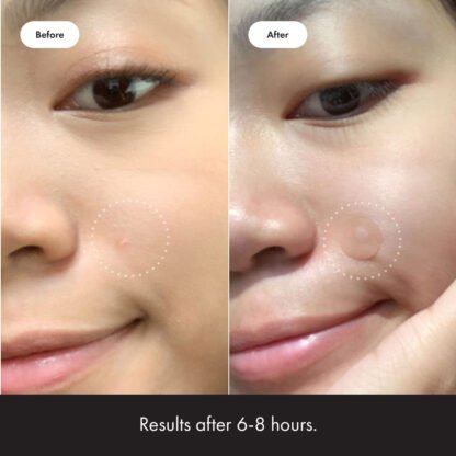 Mighty Patch Zit Zappers - Image 4